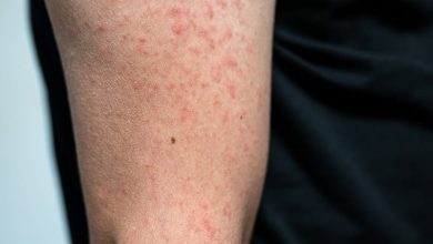 Photo of Dnevnik TVSA: U Kantonu Sarajevo laboratorijski potvrđeno 15 slučajeva zaraze morbilima